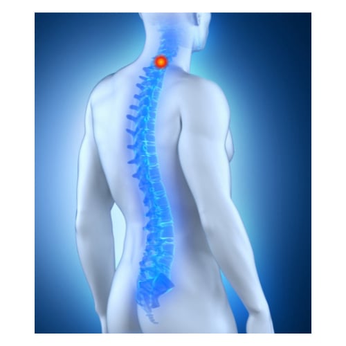 Bulging Disc at C6-C7