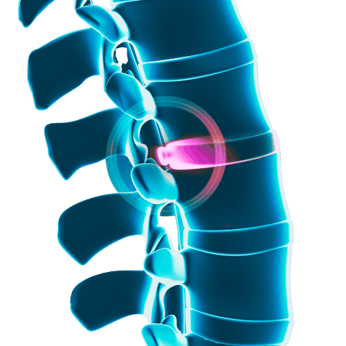Herniated Disc Alternative Treatment