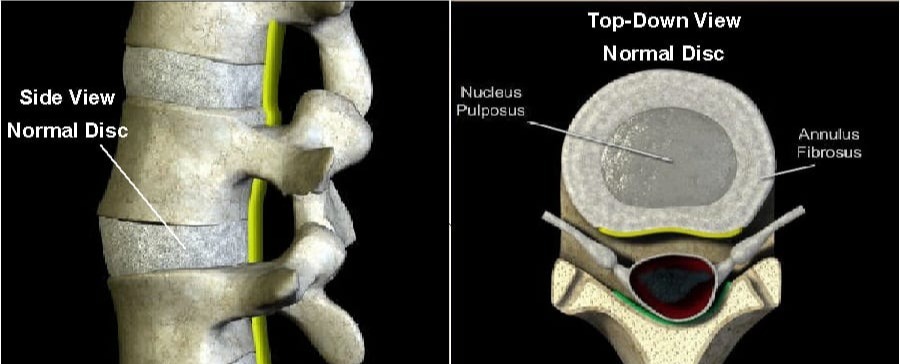 What is Discogenic Pain?