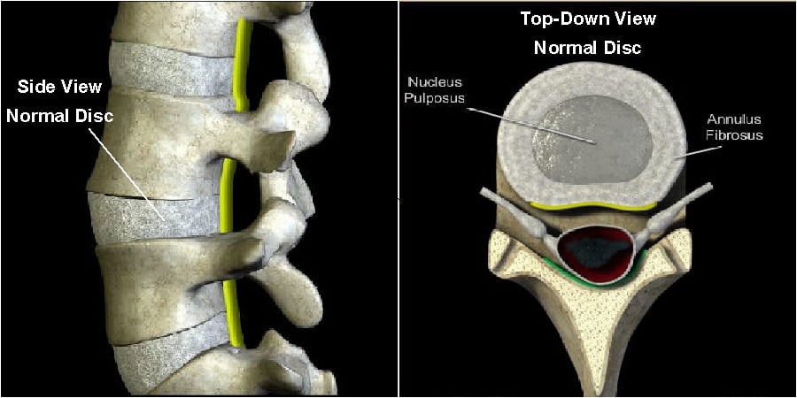 Causes of Spinal Disc Conditions