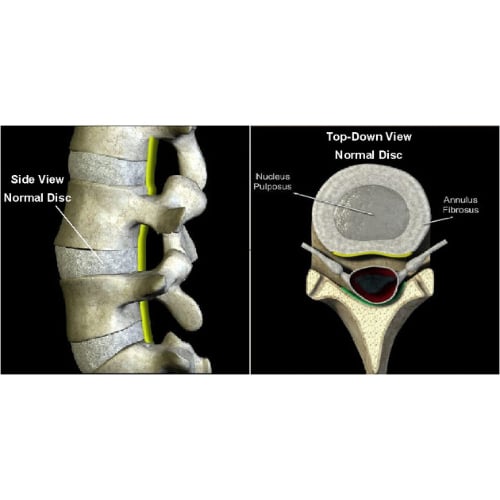 What a healthy spinal disc looks like