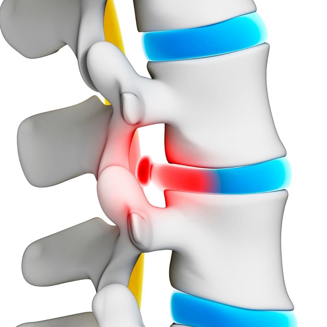 Treatment for a Herniated Disc in the Neck